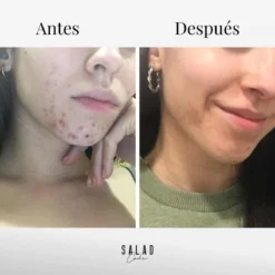 Pack Acne Balance -Cliomakeup Shop Mencionadoen 2 1